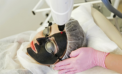 Carbon-Laser-Facial